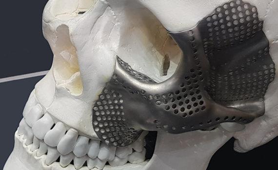 3D Printing in Medicine - Scull with Implant